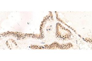 Immunohistochemistry of paraffin-embedded Human thyroid cancer tissue using RPL13A Polyclonal Antibody at dilution of 1:95(x200) (RPL13A antibody)