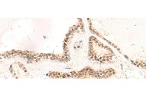 Immunohistochemistry of paraffin-embedded Human thyroid cancer tissue using RPL13A Polyclonal Antibody at dilution of 1:95(x200)
