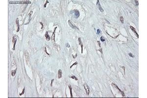 Immunohistochemical staining of paraffin-embedded Carcinoma of pancreas using anti-GATA4 (ABIN2452678) mouse monoclonal antibody.