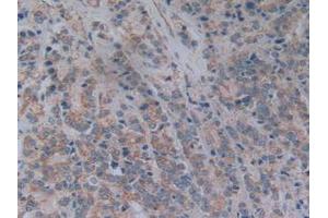 IHC-P analysis of Human Prostate Gland Cancer Tissue, with DAB staining. (NT5C3 antibody  (AA 52-336))