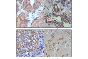 Immunohistochemical analysis of paraffin-embedded human lung cancer (A), thyroid cancer (B), lymph node (C) and brain (D) showing cytoplasmic and extracellular matrix localization using WNT5A mouse mAb with DAB staining. (WNT5A antibody)