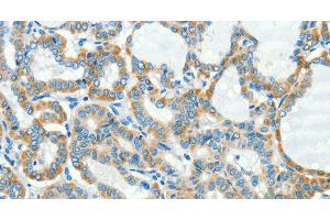 Immunohistochemistry of paraffin-embedded Human thyroid cancer tissue using L1CAM Polyclonal Antibody at dilution 1:40 (L1CAM antibody)
