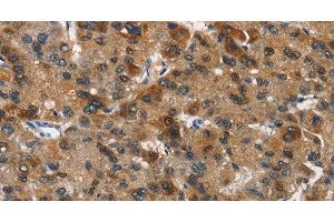 Immunohistochemistry of paraffin-embedded Human liver cancer tissue using DCC Polyclonal Antibody at dilution 1:70 (DCC antibody)