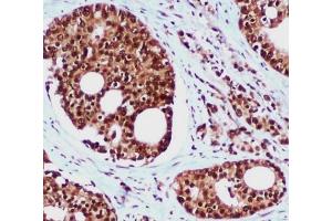 Immunohistochemical analysis of paraffin-embedded Prostate Cancer using hHR23b mouse mAb (1/100 dilution). (RAD23B antibody)