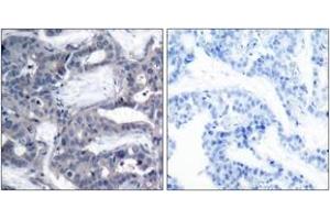 Immunohistochemistry analysis of paraffin-embedded human breast carcinoma, using MEK2 (Phospho-Thr394) Antibody. (MEK2 antibody  (AA 261-310))