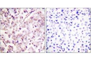 Immunohistochemistry analysis of paraffin-embedded human breast carcinoma, using ETS1 (Phospho-Thr38) Antibody. (ETS1 antibody  (pThr38))
