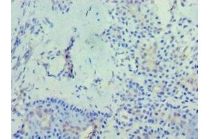 Immunohistochemistry of paraffin-embedded human breast cancer using ABIN7163439 at dilution of 1:100 (PHYH antibody  (AA 1-338))