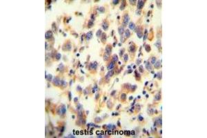 UGT3A2 antibody (C-term) immunohistochemistry analysis in formalin fixed and paraffin embedded human testis carcinoma followed by peroxidase conjugation of the secondary antibody and DAB staining. (UGT3A2 antibody  (C-Term))