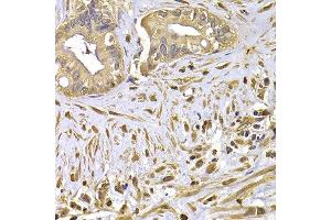 Immunohistochemistry of paraffin-embedded human liver cancer using FSCN1 antibody at dilution of 1:100 (x400 lens).