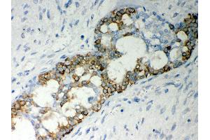 Anti- Caspase-7 Picoband antibody,IHC(P) IHC(P): Human Mammary Cancer Tissue