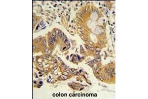 Formalin-fixed and paraffin-embedded human colon carcinoma reacted with CLNS1A Antibody (Center), which was peroxidase-conjugated to the secondary antibody, followed by DAB staining.