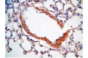 Mouse lung cancer tissue stained by Rabbit Anti-CRAMP (Mouse) Antibody (Cathelicidin antibody  (AA 140-173))