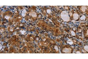 Immunohistochemistry of paraffin-embedded Human thyroid cancer using CD116 Polyclonal Antibody at dilution of 1:35 (CSF2RA antibody)