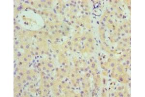 Immunohistochemistry of paraffin-embedded human liver cancer using ABIN7148380 at dilution of 1:100 (Complement Factor B antibody  (AA 26-751))