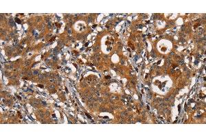 Immunohistochemistry of paraffin-embedded Human gastric cancer tissue using CEACAM3 Polyclonal Antibody at dilution 1:30 (CEACAM3 antibody)