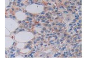 IHC-P analysis of Human Skin Cancer Tissue, with DAB staining. (FKBP7 antibody  (AA 24-217))
