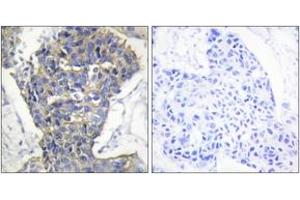 Immunohistochemistry analysis of paraffin-embedded human breast carcinoma tissue, using MUNC-18a (Ab-313) Antibody.