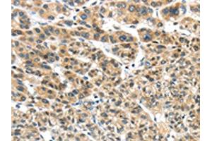 The image on the left is immunohistochemistry of paraffin-embedded Human liver cancer tissue using (TKTL1 Antibody) at dilution 1/40, on the right is treated with fusion protein. (TKTL1 antibody)