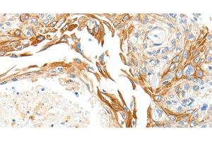 Immunohistochemistry of paraffin-embedded Human esophagus cancer using PLAT Polyclonal Antibody at dilution of 1:50