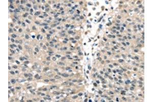 The image on the left is immunohistochemistry of paraffin-embedded Human breast cancer tissue using ABIN7128063(UCHL3 Antibody) at dilution 1/25, on the right is treated with fusion protein. (UCHL3 antibody)