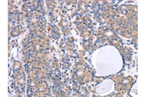 The image on the left is immunohistochemistry of paraffin-embedded Human thyroid cancer tissue using ABIN7190789(GFRA4 Antibody) at dilution 1/40, on the right is treated with synthetic peptide. (GFRA4 antibody)