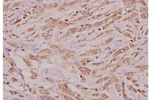 Immunohistochemistry analysis of Connexin-32 antibody in paraffin-embedded human breast carcinoma tissue at 1/100 dilution. (GJB1 antibody)