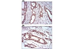 Immunohistochemical staining of cervical cancer tissues (A) and colon cancer tissues (B) with KHDRBS2 monoclonal antibody, clone 7G8C10  at 1:200-1:1000 dilution.