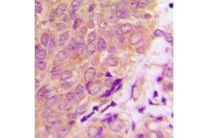 Immunohistochemical analysis of Caspase 6 staining in human prostate cancer formalin fixed paraffin embedded tissue section. (Caspase 6 antibody  (C-Term))
