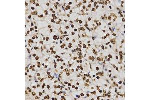 Immunohistochemistry of paraffin-embedded human kidney cancer using TriMethyl-Histone H4-K20 antibody. (Histone H4 antibody  (3meLys20))