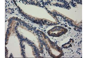 Immunohistochemical staining of paraffin-embedded Carcinoma of Human prostate tissue using anti-RASD2 mouse monoclonal antibody.