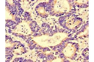 Immunohistochemistry of paraffin-embedded human colon cancer using ABIN7143463 at dilution of 1:100 (GGA1 antibody  (AA 1-89))