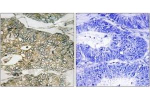 Immunohistochemistry analysis of paraffin-embedded human colon carcinoma, using GRB2 (Phospho-Ser159) Antibody. (GRB2 antibody  (pSer159))