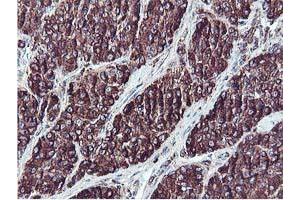 Immunohistochemical staining of paraffin-embedded Carcinoma of Human liver tissue using anti-ILVBL mouse monoclonal antibody.