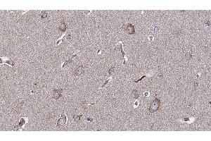 ABIN6276906 at 1/100 staining Human brain cancer tissue by IHC-P. (IL-10RA antibody  (C-Term))