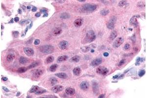 Anti-ESRRA antibody  ABIN1048580 IHC staining of human breast carcinoma. (ESRRA antibody  (Internal Region))