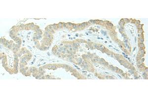 Immunohistochemistry of paraffin-embedded Human thyroid cancer tissue using EVI2B Polyclonal Antibody at dilution of 1:40(x200) (EVI2B antibody)
