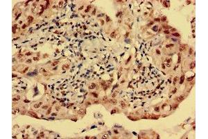 Immunohistochemistry analysis of human lung cancer using ABIN7142618 at dilution of 1:100 (Serotonin Receptor 1E antibody  (AA 203-291))