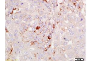 Formalin-fixed and paraffin embedded human lung carcinoma labeled with Anti-RGS2 Polyclonal Antibody, Unconjugated (ABIN669291) at 1:200 followed by conjugation to the secondary antibody and DAB staining.
