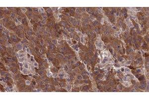ABIN6277377 at 1/100 staining Human liver cancer tissue by IHC-P. (Metabotropic Glutamate Receptor 1 antibody  (Internal Region))