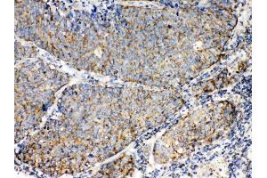 TECTA was detected in paraffin-embedded sections of human lung cancer tissues using rabbit anti- TECTA Antigen Affinity purified polyclonal antibody (Catalog # ) at 1 µg/mL. (TECTA antibody  (N-Term))