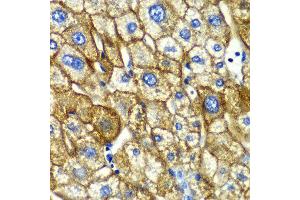 Immunohistochemistry of paraffin-embedded human liver injury using ASGR1 antibody at dilution of 1:100 (x40 lens).