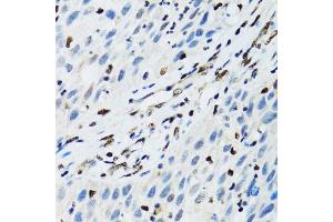 Immunohistochemistry of paraffin-embedded human lung cancer using FLI1 antibody (ABIN1876845) at dilution of 1:100 (40x lens). (FLI1 antibody)