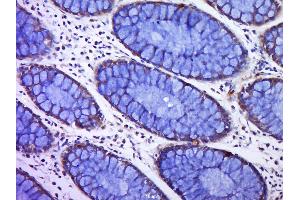 Paraformaldehyde-fixed, paraffin embedded human colon cancer, Antigen retrieval by boiling in sodium citrate buffer (pH6. (C12orf42 antibody)