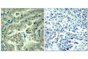 Immunohistochemical analysis of paraffin-embedded human lung carcinoma tissue using eIF4G(Phospho-Ser1232) Antibody(left) or the same antibody preincubated with blocking peptide(right). (EIF4G1 antibody  (pSer1232))