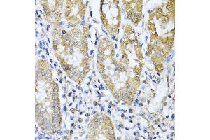 Immunohistochemistry of paraffin-embedded human gastric cancer using ASIP antibody at dilution of 1:100 (40x lens). (ASIP antibody)