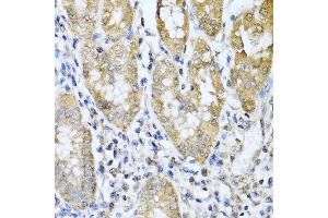 Immunohistochemistry of paraffin-embedded human gastric cancer using ASIP antibody at dilution of 1:100 (40x lens).