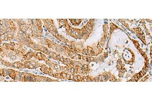 Immunohistochemistry of paraffin-embedded Human thyroid cancer tissue using FARP2 Polyclonal Antibody at dilution of 1:70(x200) (FARP2 antibody)