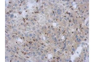 IHC-P Image Immunohistochemical analysis of paraffin-embedded U373 xenograft, using NDUFV1, antibody at 1:500 dilution. (NDUFV1 antibody  (Center))