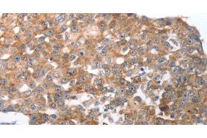 Immunohistochemistry of paraffin-embedded Human breast cancer using NQO2 Polyclonal Antibody at dilution of 1:50 (NQO2 antibody)
