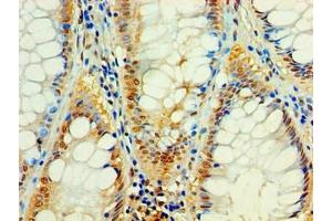 Immunohistochemistry of paraffin-embedded human colon cancer using ABIN7174852 at dilution of 1:100 (C4ORF3 antibody  (AA 1-44))